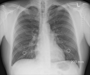 lung x-ray